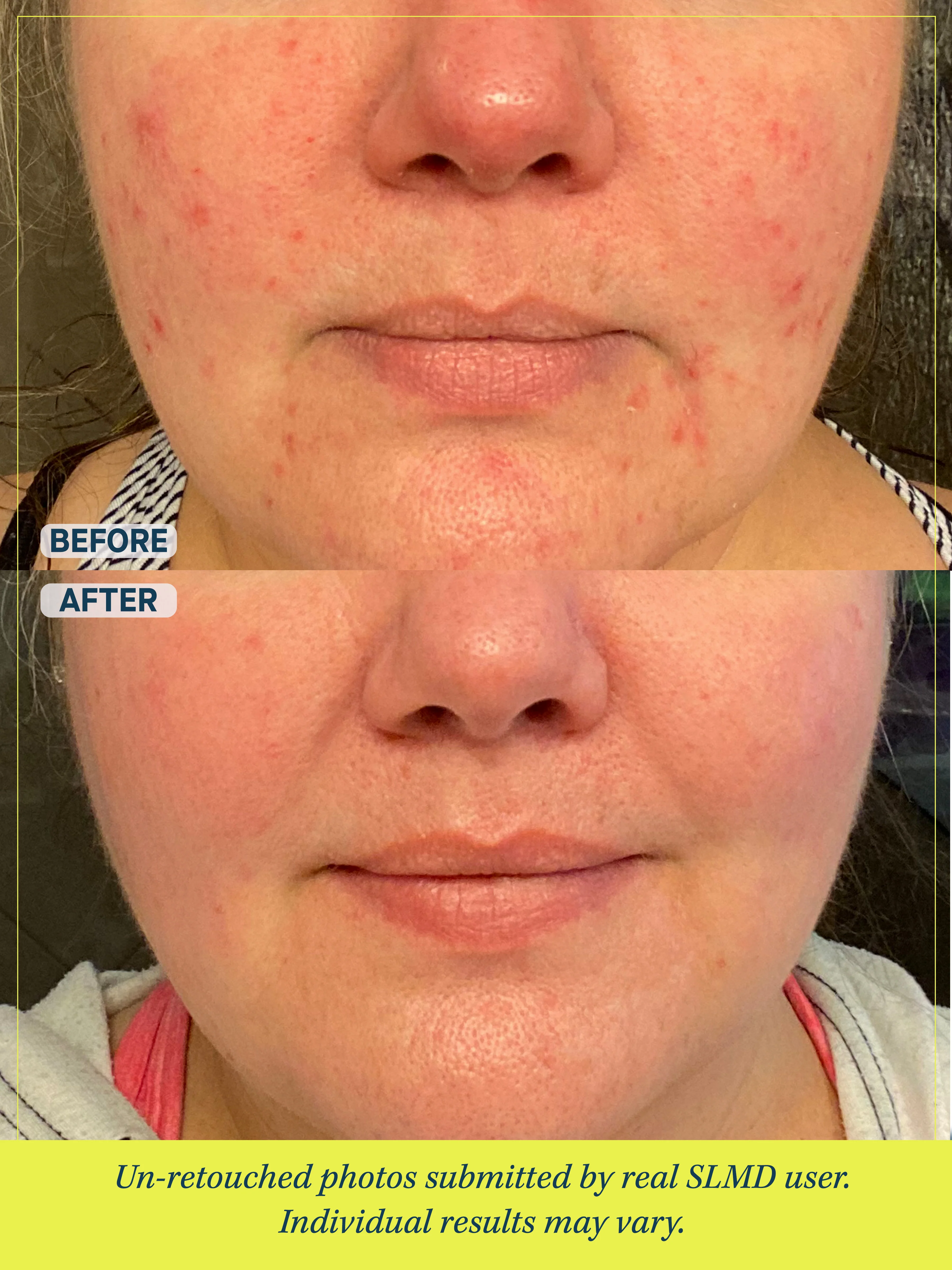 Acne System - Image 4