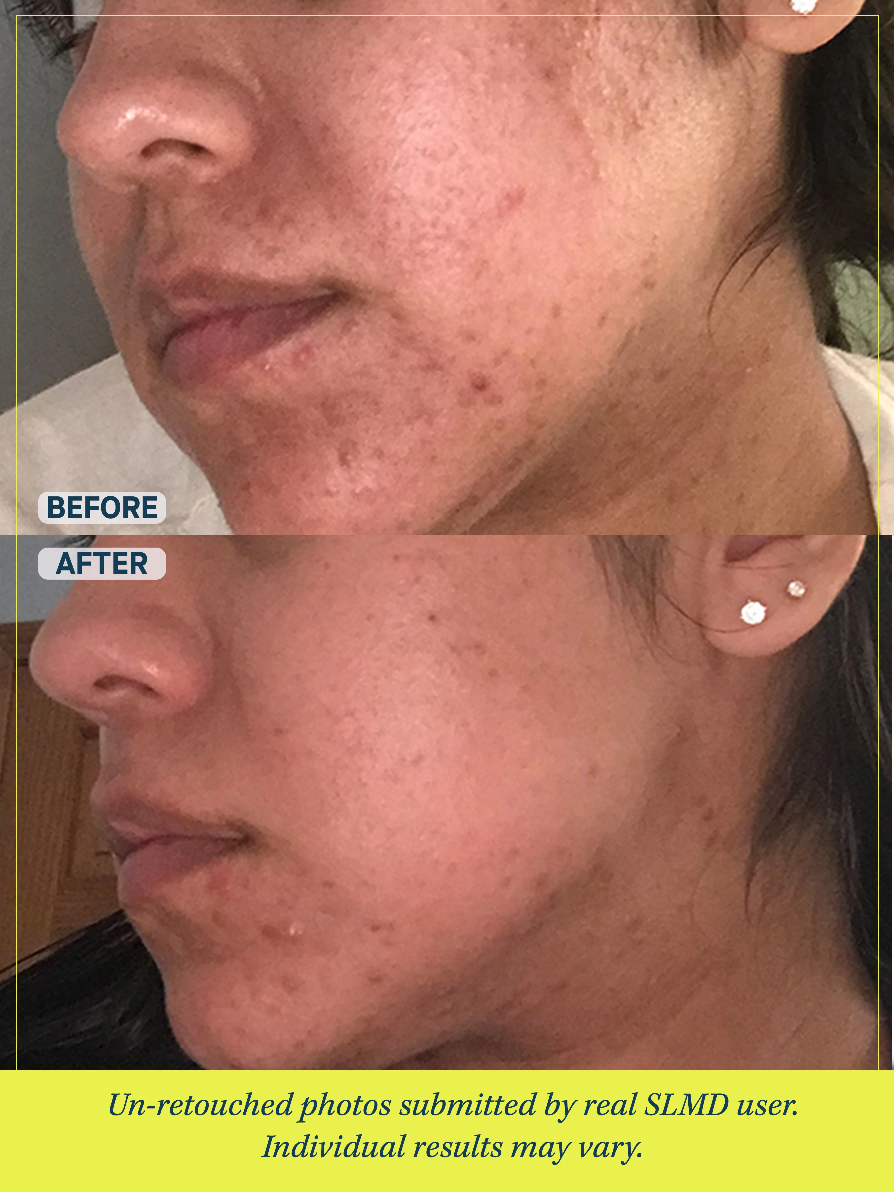 Acne System - Image 5