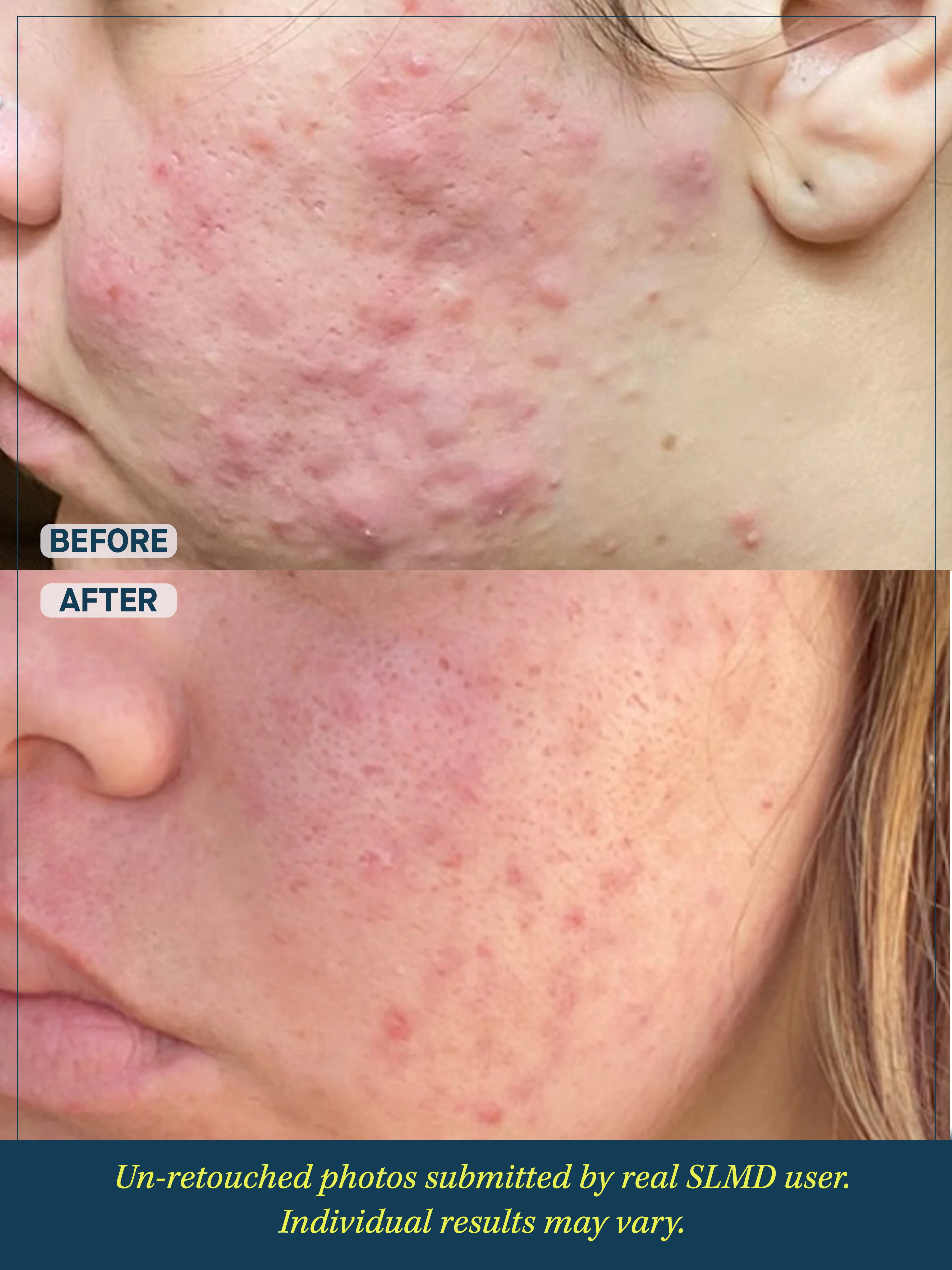 Acne System - Image 6