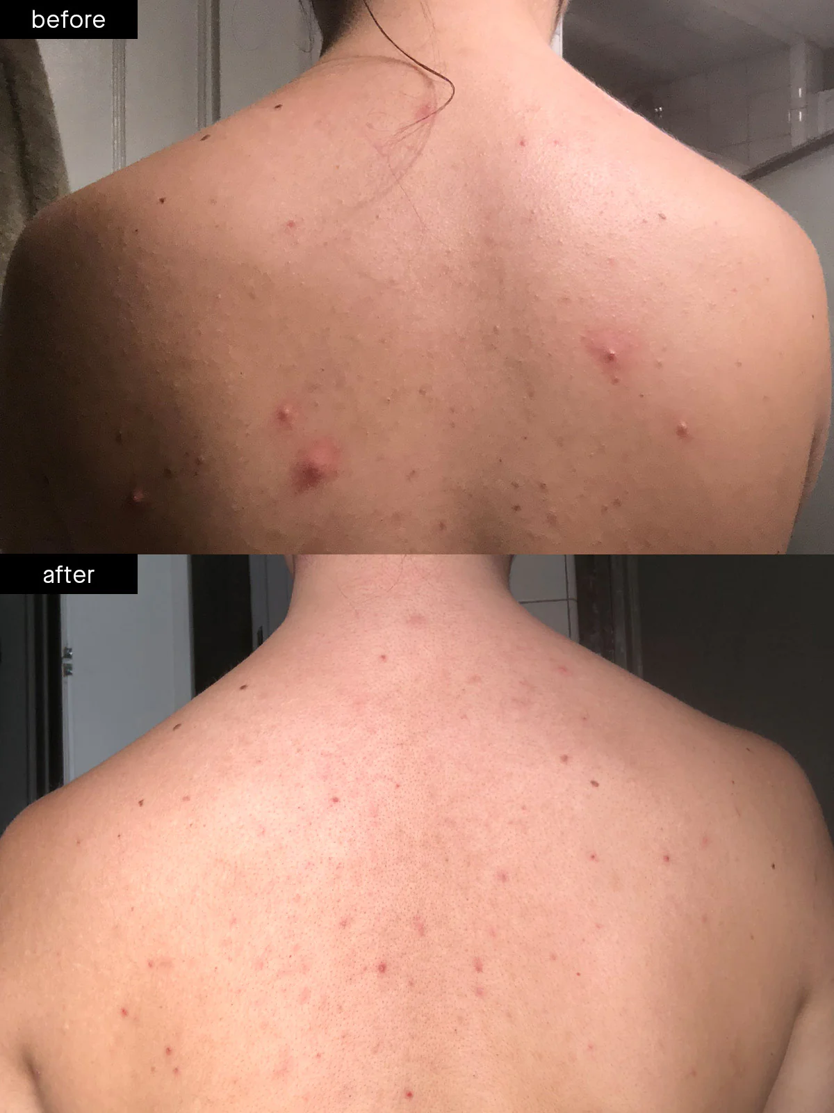 Body Acne System - Image 5